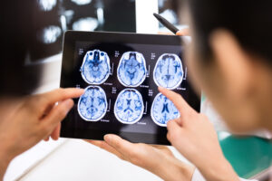 Diagnose Brain Injury After a Car Accident