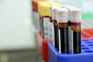 LA and Orange County Injury Attorney Tests for STDs