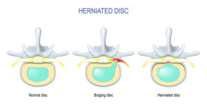 back injury lawyer Orange County Los Angeles Inland Empire