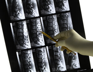 Orange County CA Back Injury Attorney