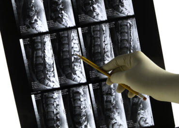 Orange County CA Back Injury Attorney